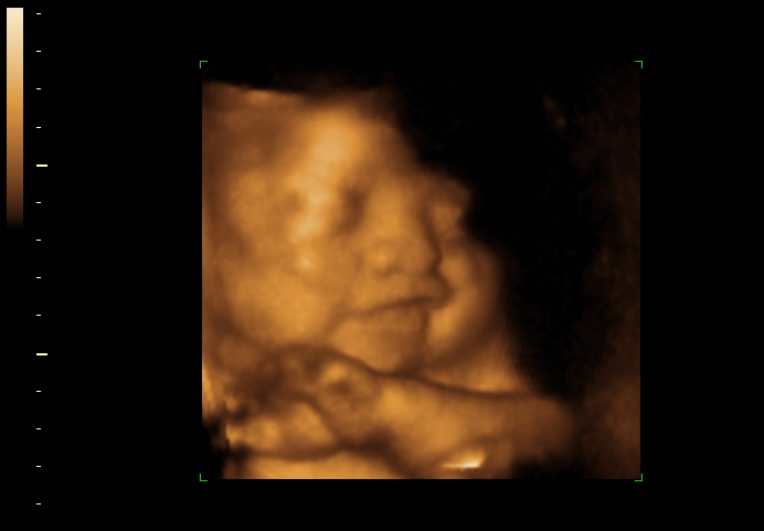 3D ultrasound image at 33 weeks